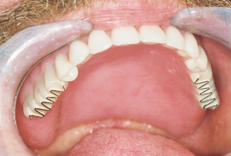 Permanent Dentures Procedure Mc Dade TX 78650